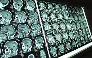 Concussions and Alzheimer's disease